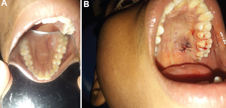 (A) Soft tissue palatal mass. (B) Postoperative photograph after closure.